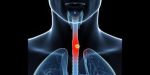 Carcinoma superficiale dell’esofago: trattamento endoscopico