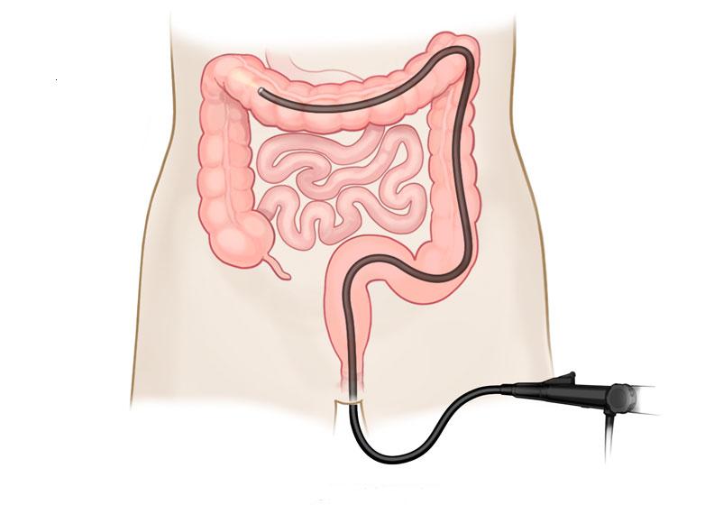 dieta dopo polipectomia colon