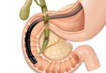 ERCP – Colangio-  pancreatografia  retrograda  endoscopica