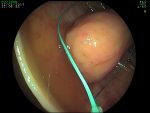Lipoma del colon