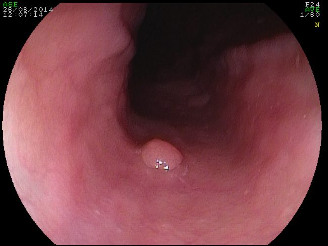 analize viermi intestinali copii dacă partenerul are condilom