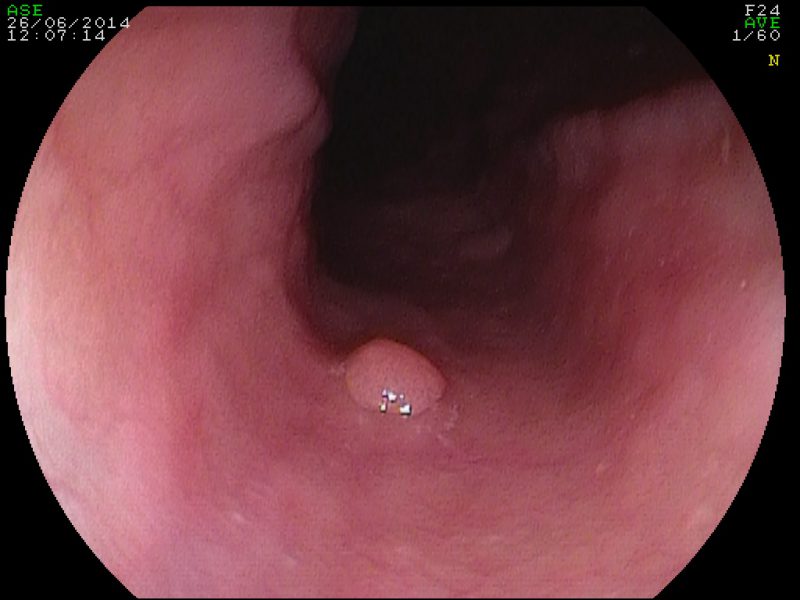Papilloma Squamoso Della Mucosa Esofagea