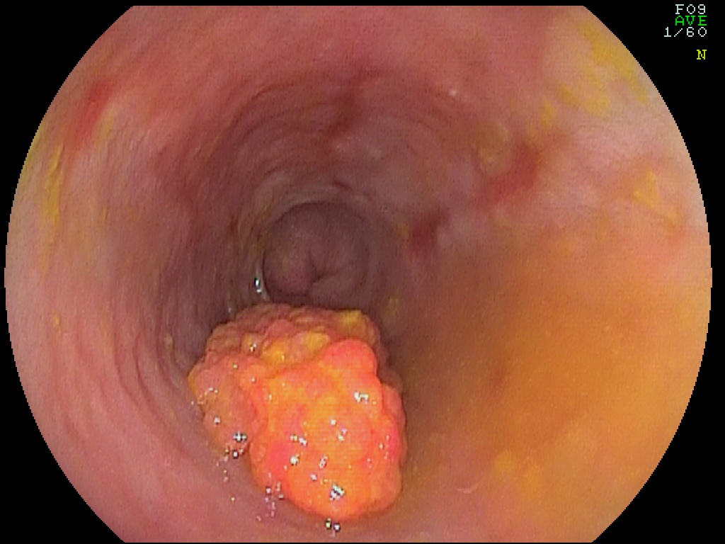 Prostata La Barbati Simptome - Frammenti di papilloma a cellule squamose