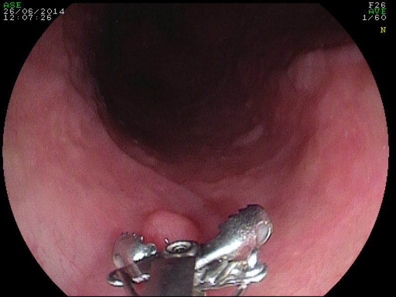 Papilloma Squamoso Della Mucosa Esofagea