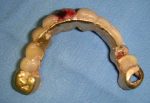 Aiuto. La nonna ha ingoiato la dentiera.