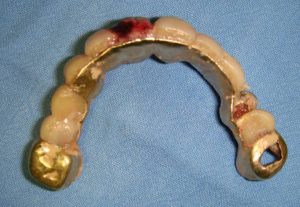 Aiuto. La nonna ha ingoiato la dentiera.