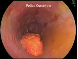 Papilloma Squamoso Della Mucosa Esofagea