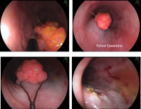 Papilloma Squamoso Della Mucosa Esofagea
