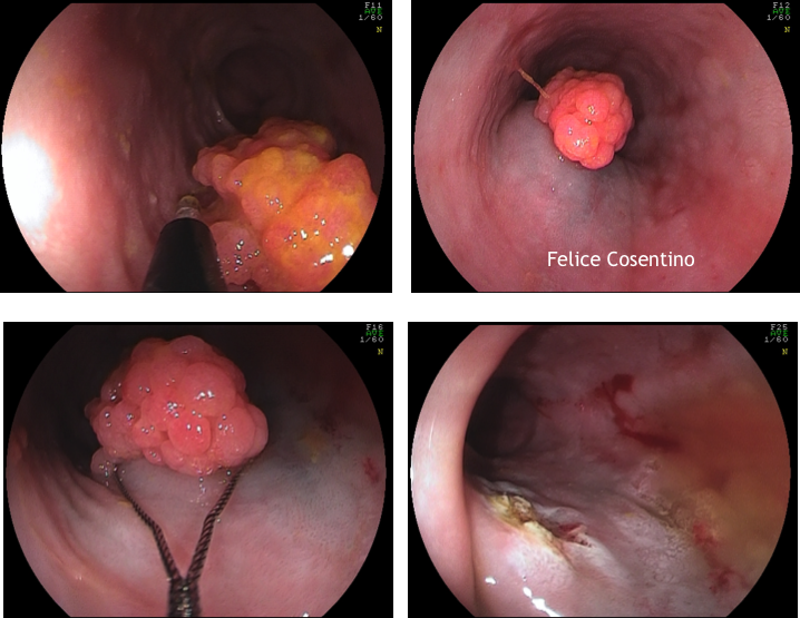 papilloma eltávolító ceruza