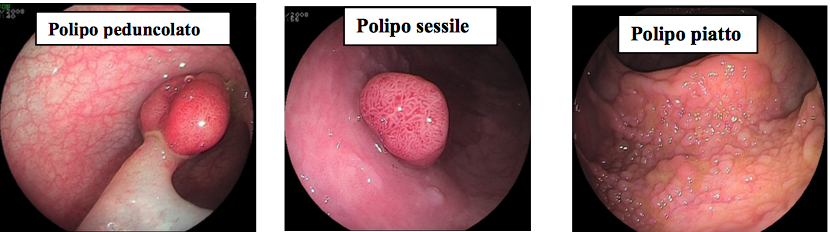 Síntomas después de quitar un pólipo uterino